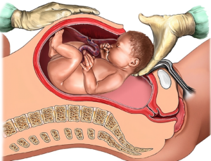 Cesarean (C-section)